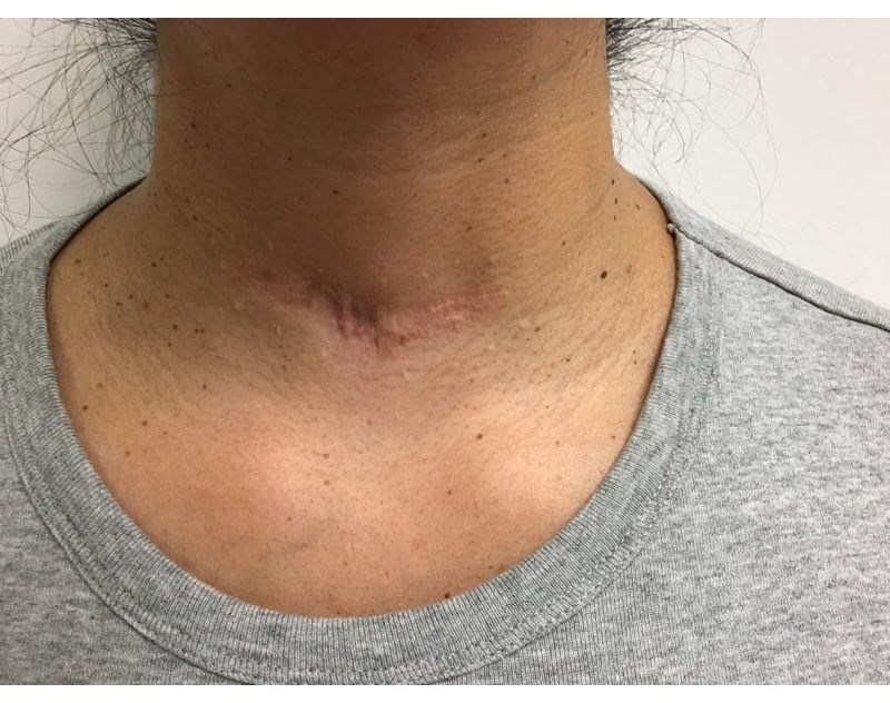 Neck After