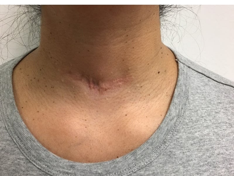 Neck After