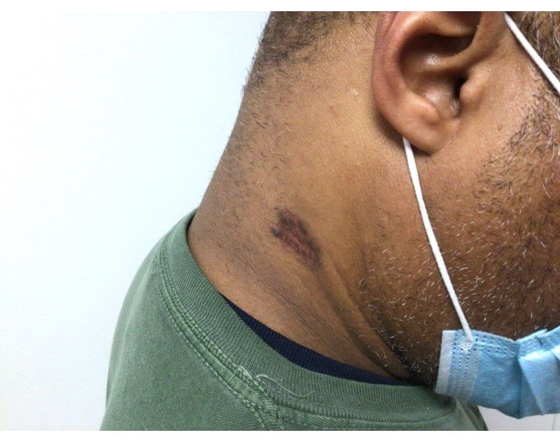 Neck After