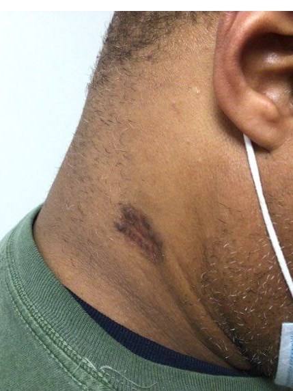 Neck After