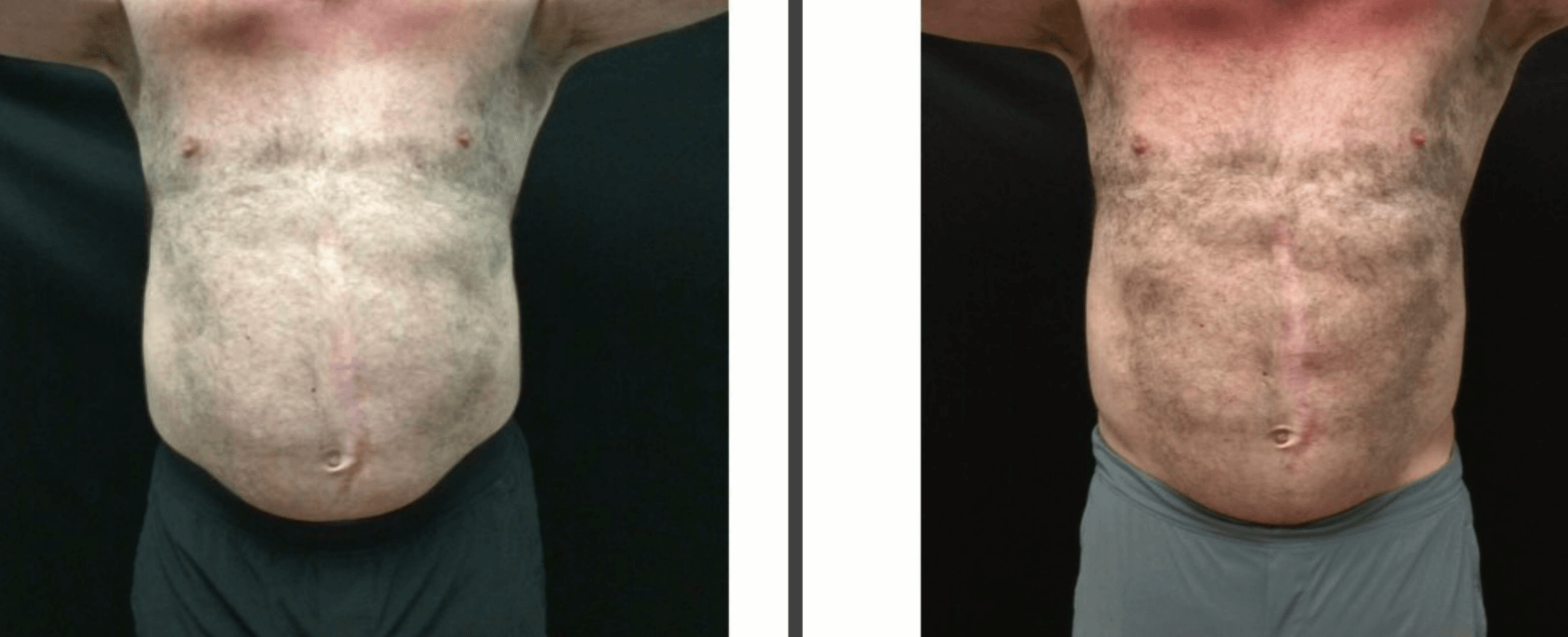 Abdomen Before
