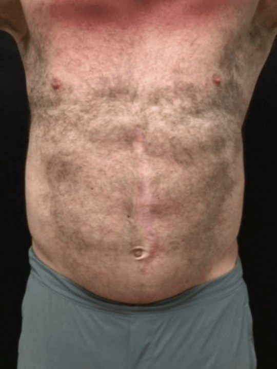Abdomen After