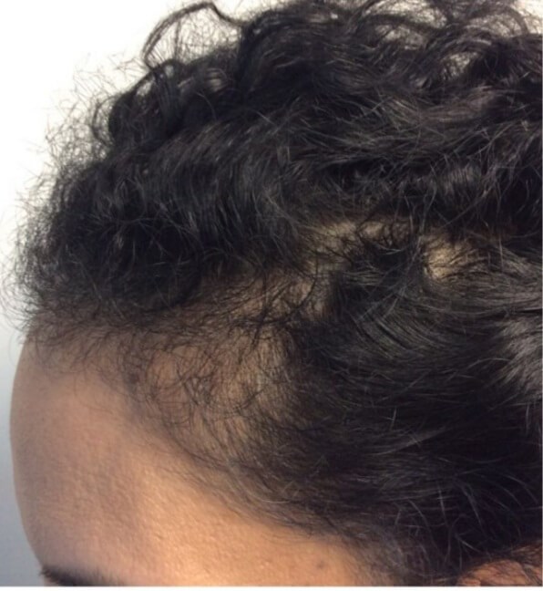 Side View Before