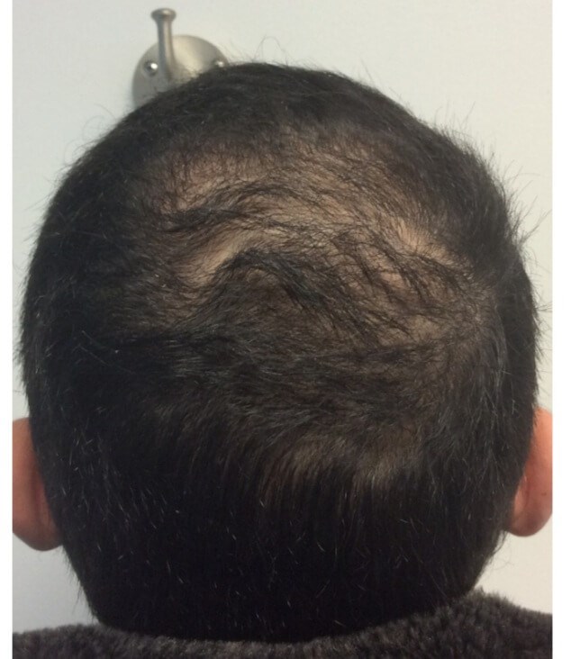 Back of Scalp After