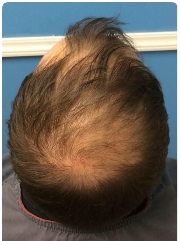 Scalp After