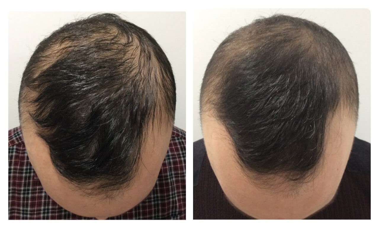 Scalp Before