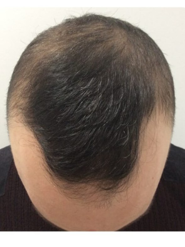Scalp After