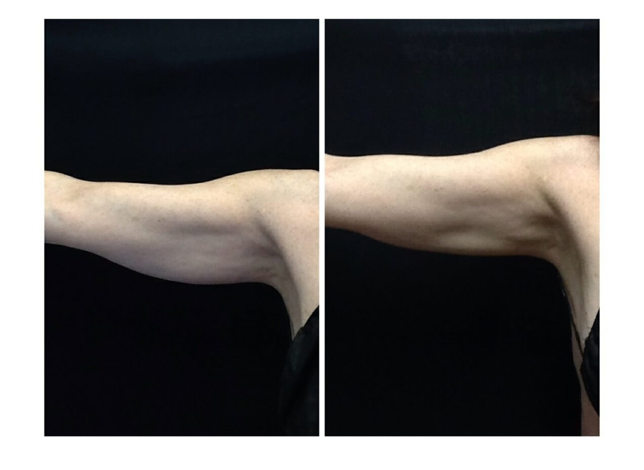 Arms Before