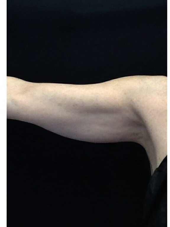 Arms Before