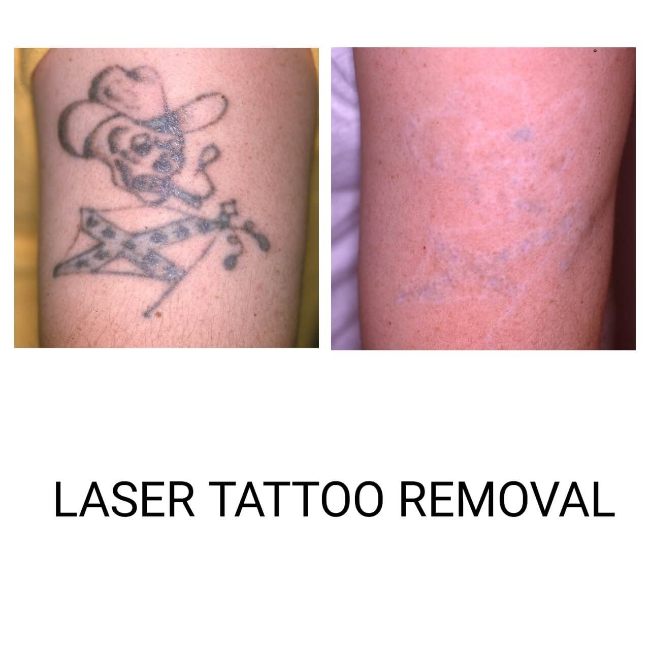Arm Before