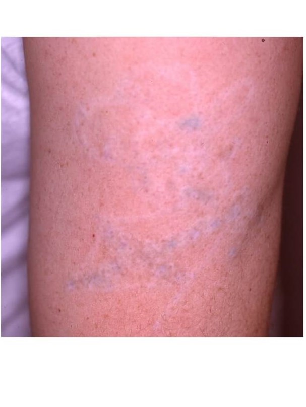 Arm After