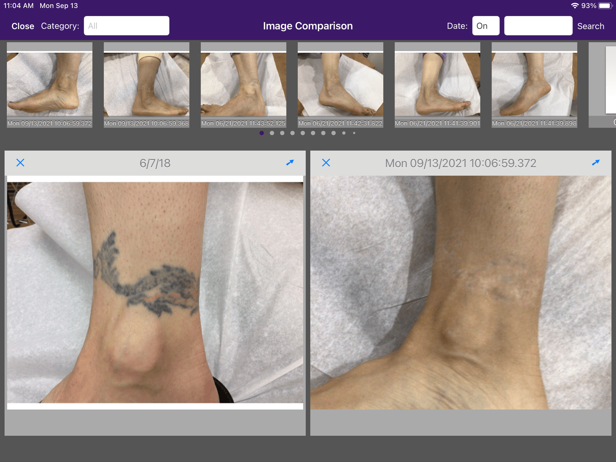 Ankle Before