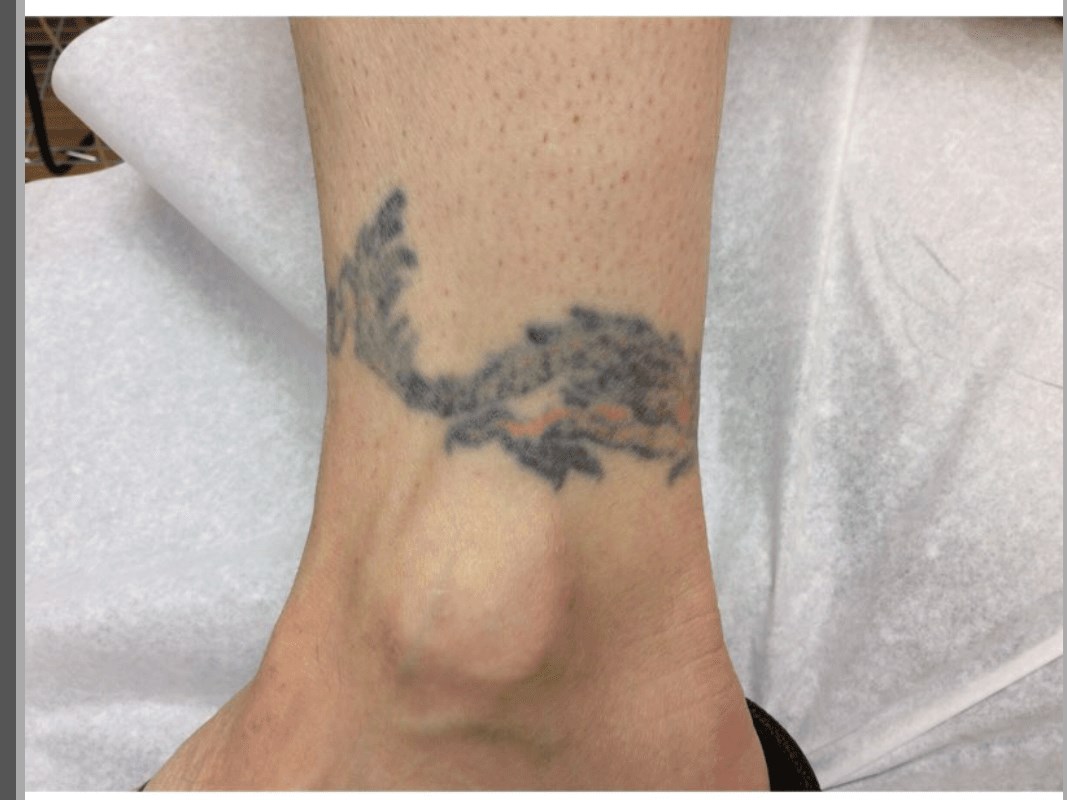 Ankle Before