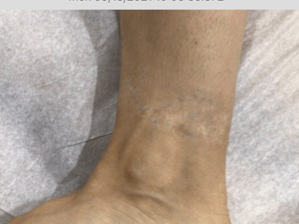 Ankle After