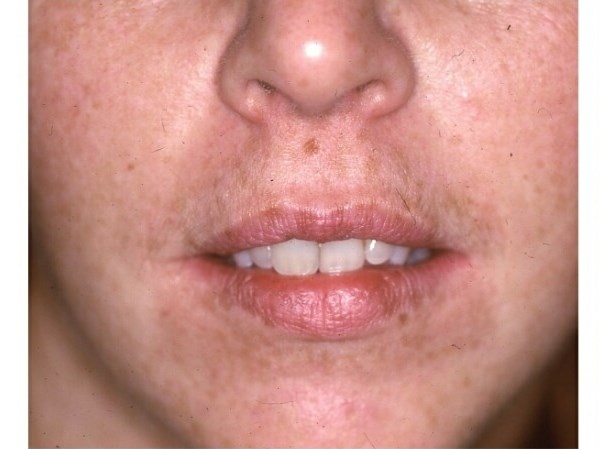 Front View Before