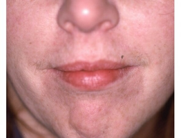 Front View After