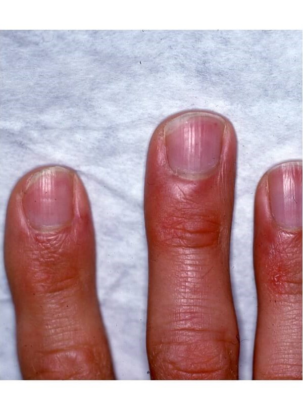 Fingers After