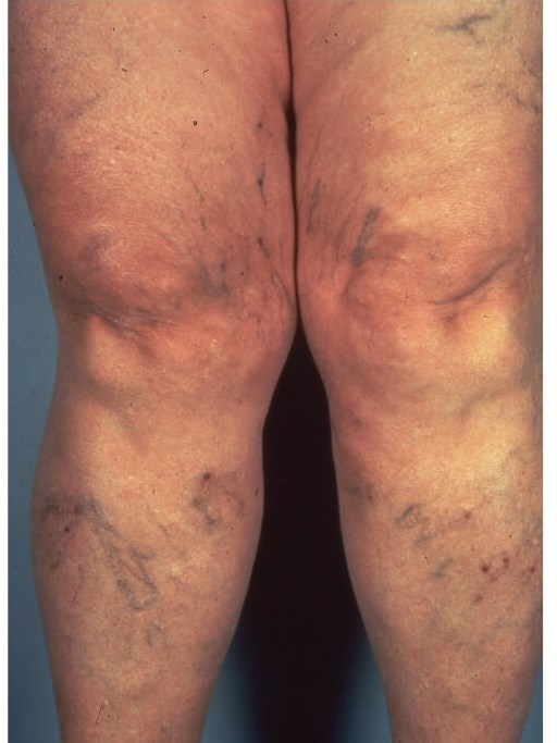 Legs Before