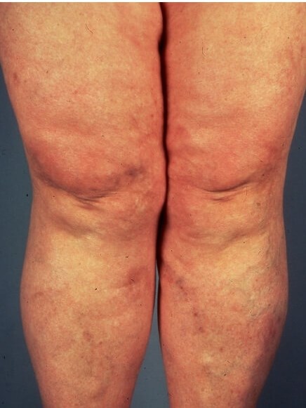 Legs After