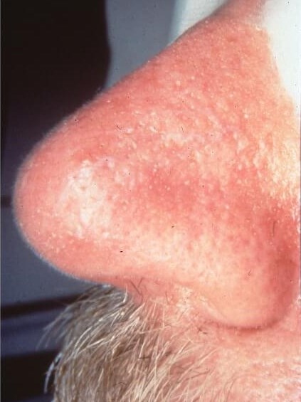 Nose After