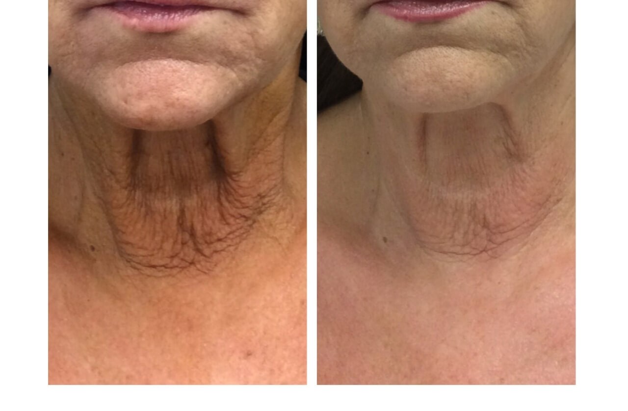 Neck Before