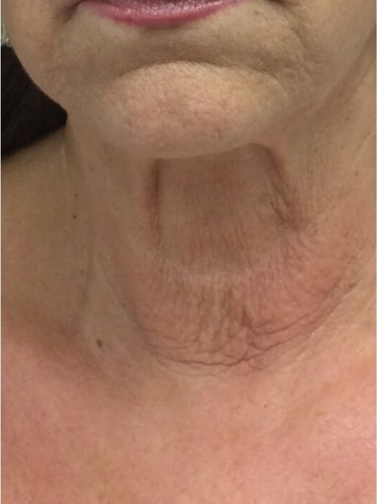 Neck After