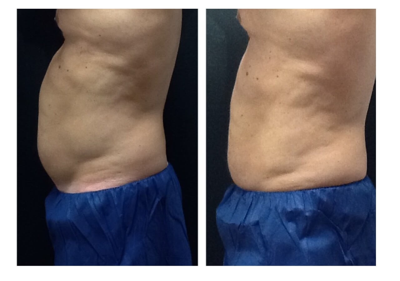 Stomach Before
