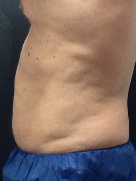 Stomach After