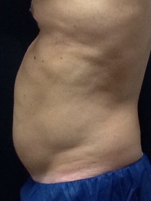Stomach Before
