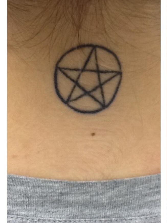 Laser Tattoo Removal Before After Photos Bodian Dermatology Laser Tattoo Removal Before After Photos Bodian Dermatology