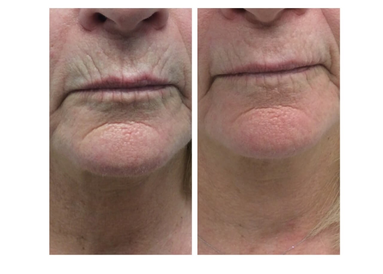Around Lips Before