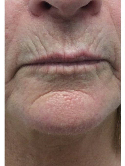 Around Lips Before