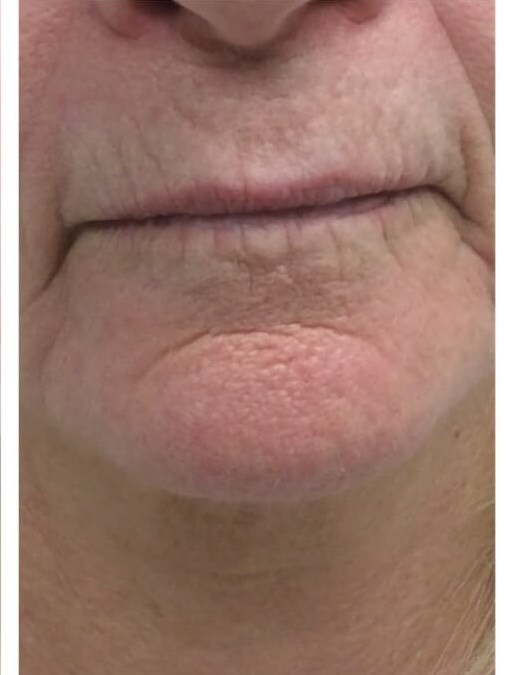 Around Lips After
