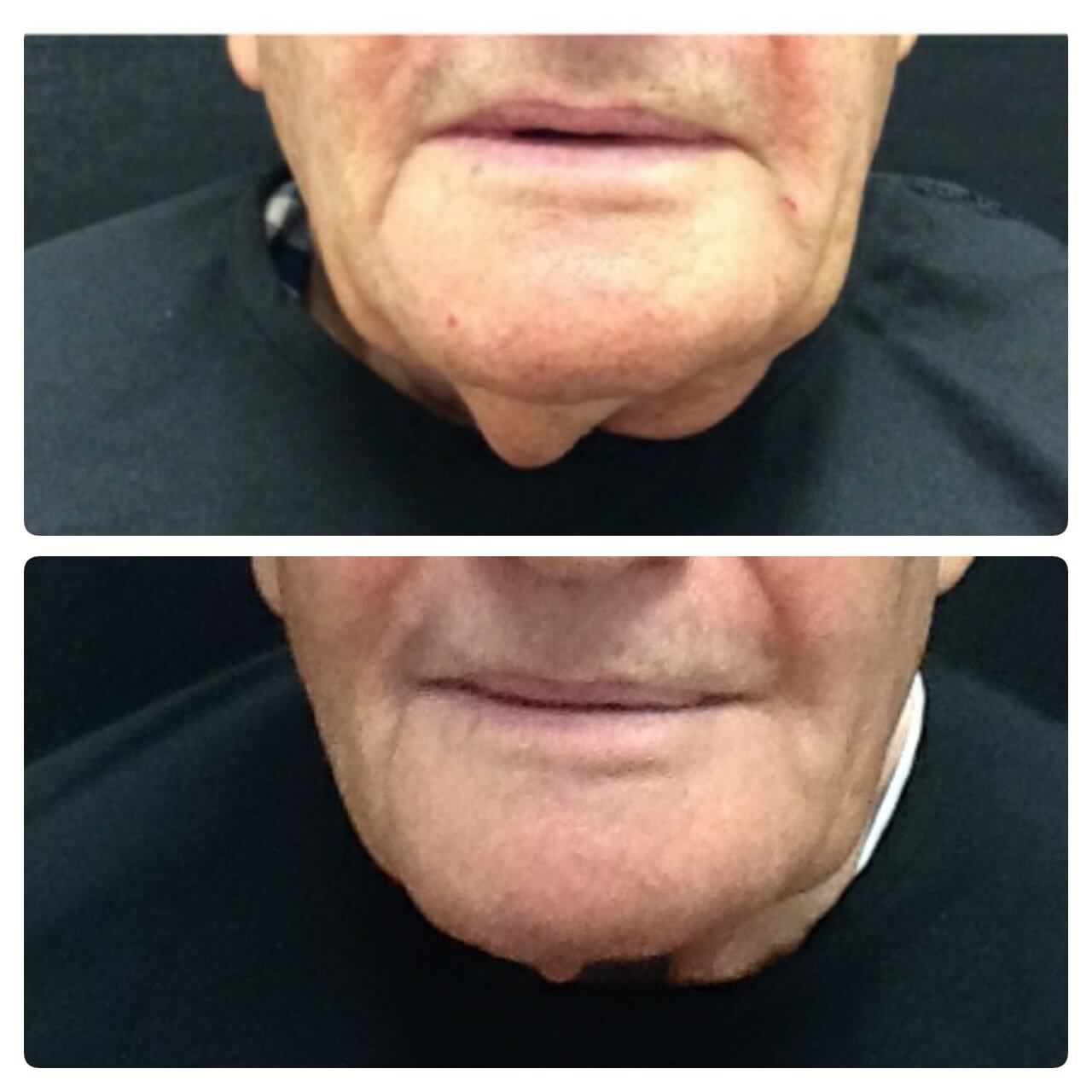Neck Before