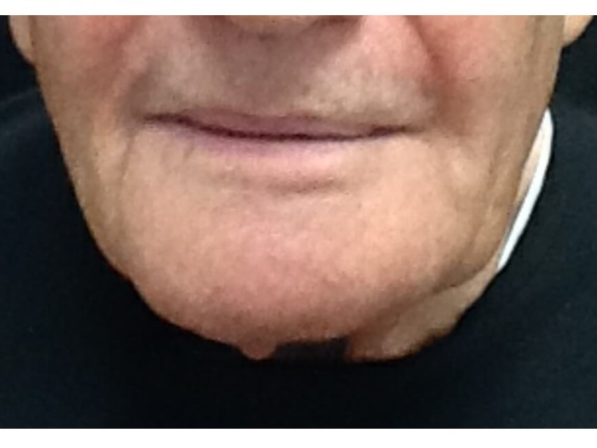 Neck After