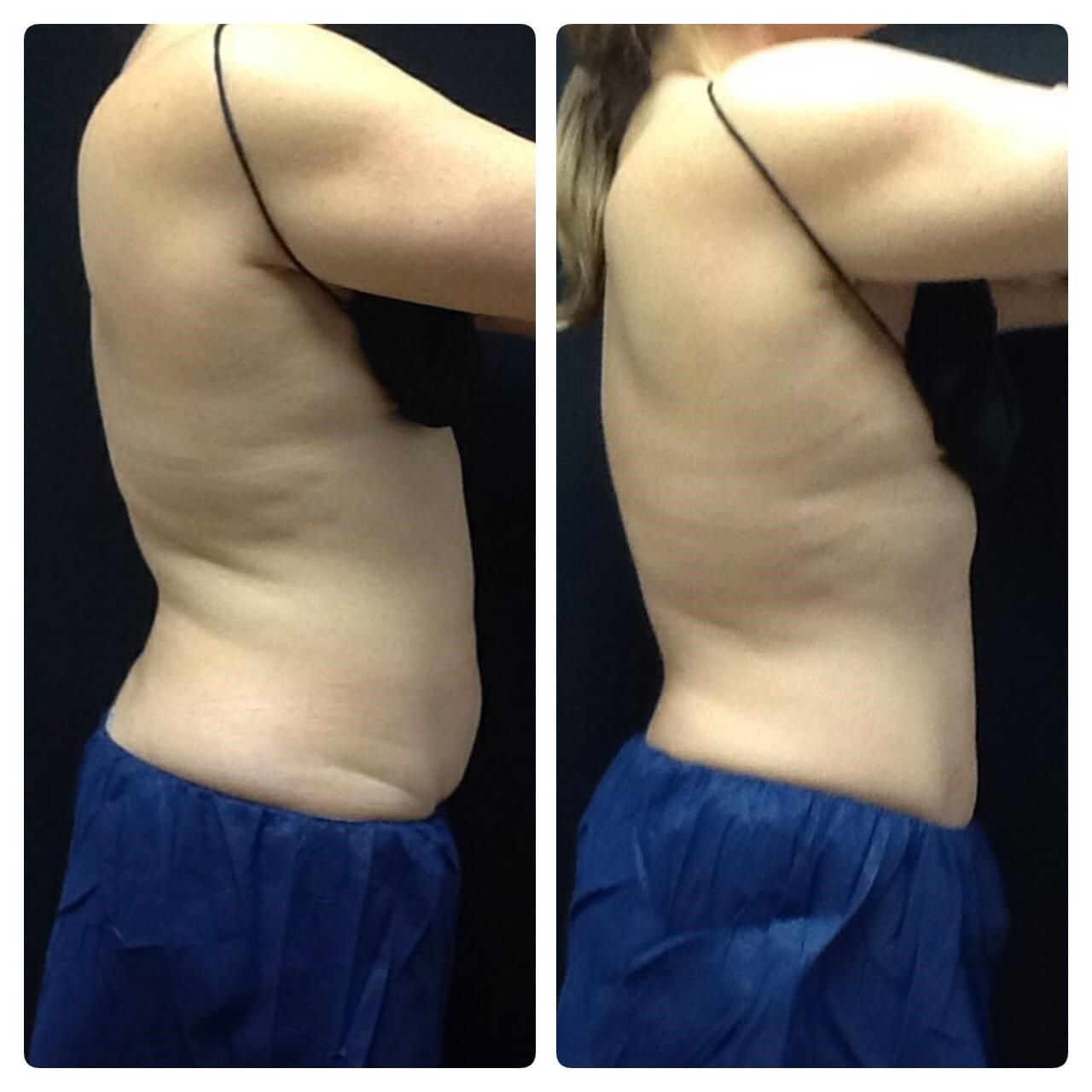 Stomach Before