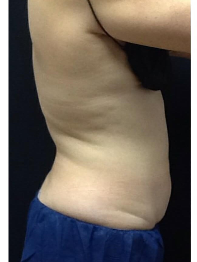 Stomach Before