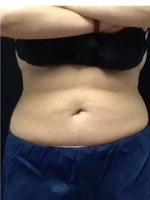 Front View After