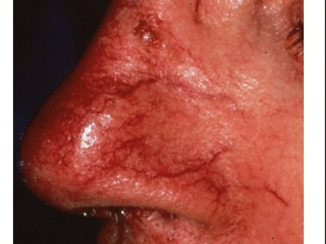 Nose Before
