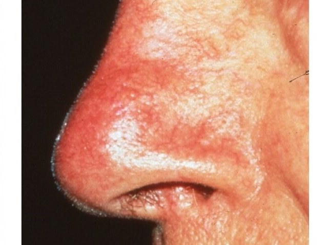 Nose After