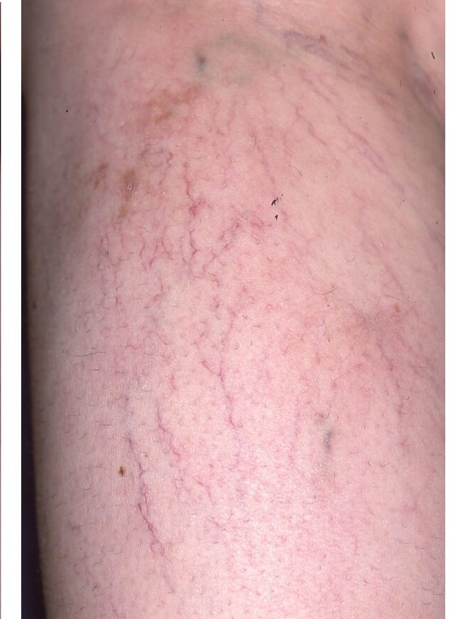 Legs After
