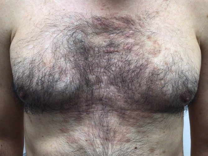 Chest After