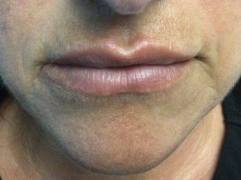 Lips After