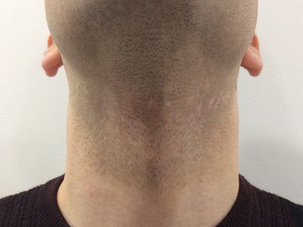 Neck After