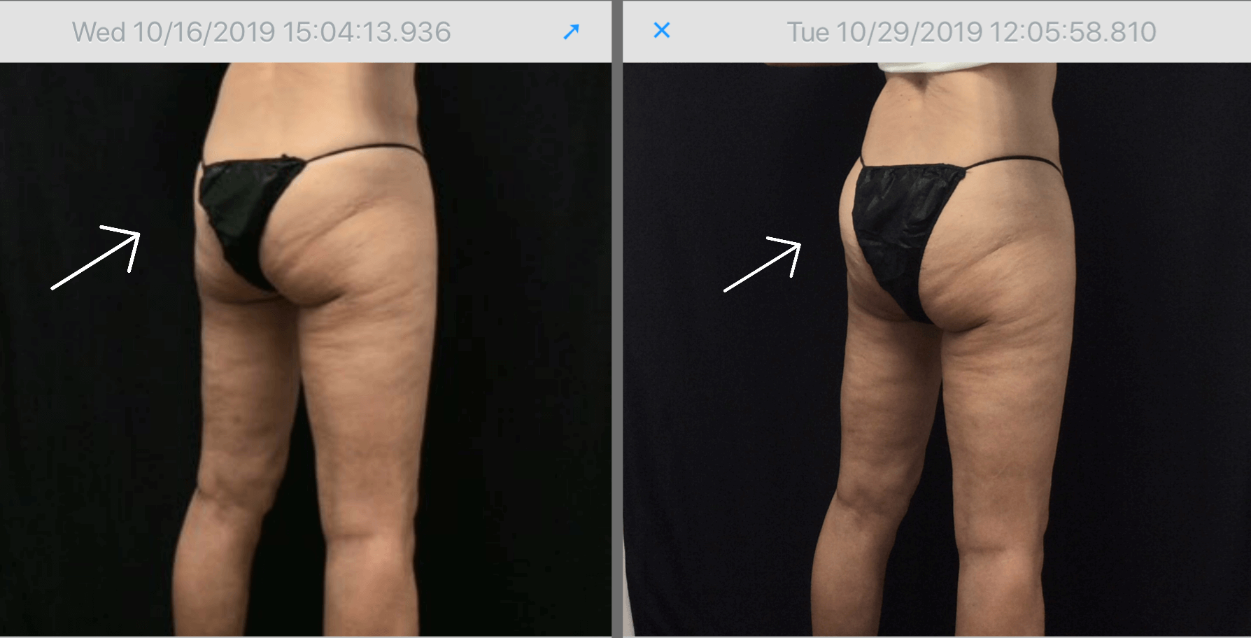 Buttock Before