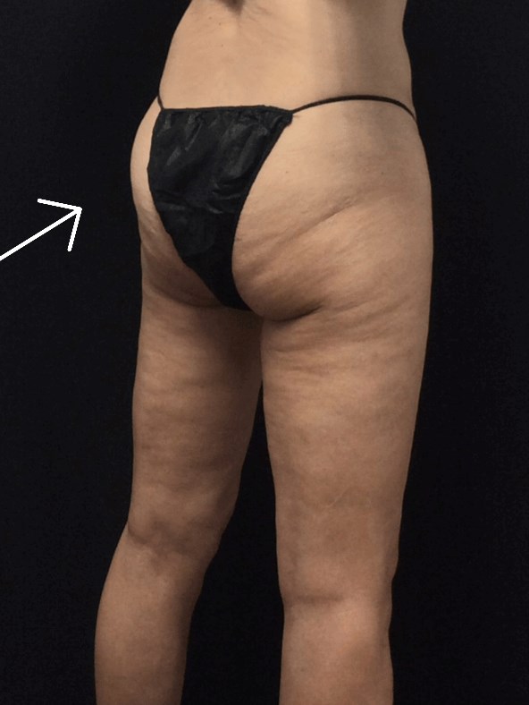 Buttock After