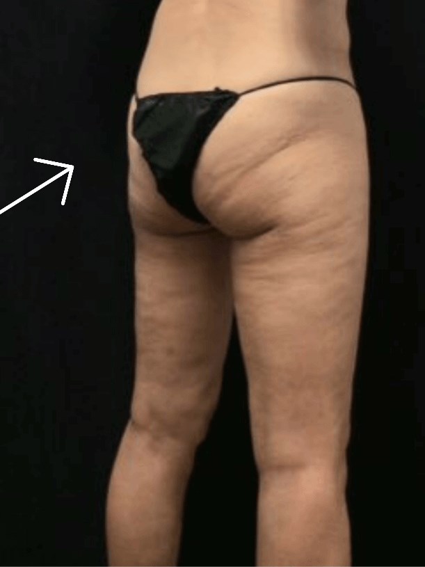 Buttock Before