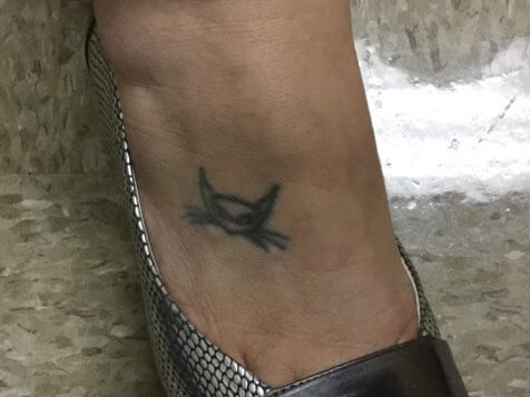 Before and After Laser Tattoo Removal Photos