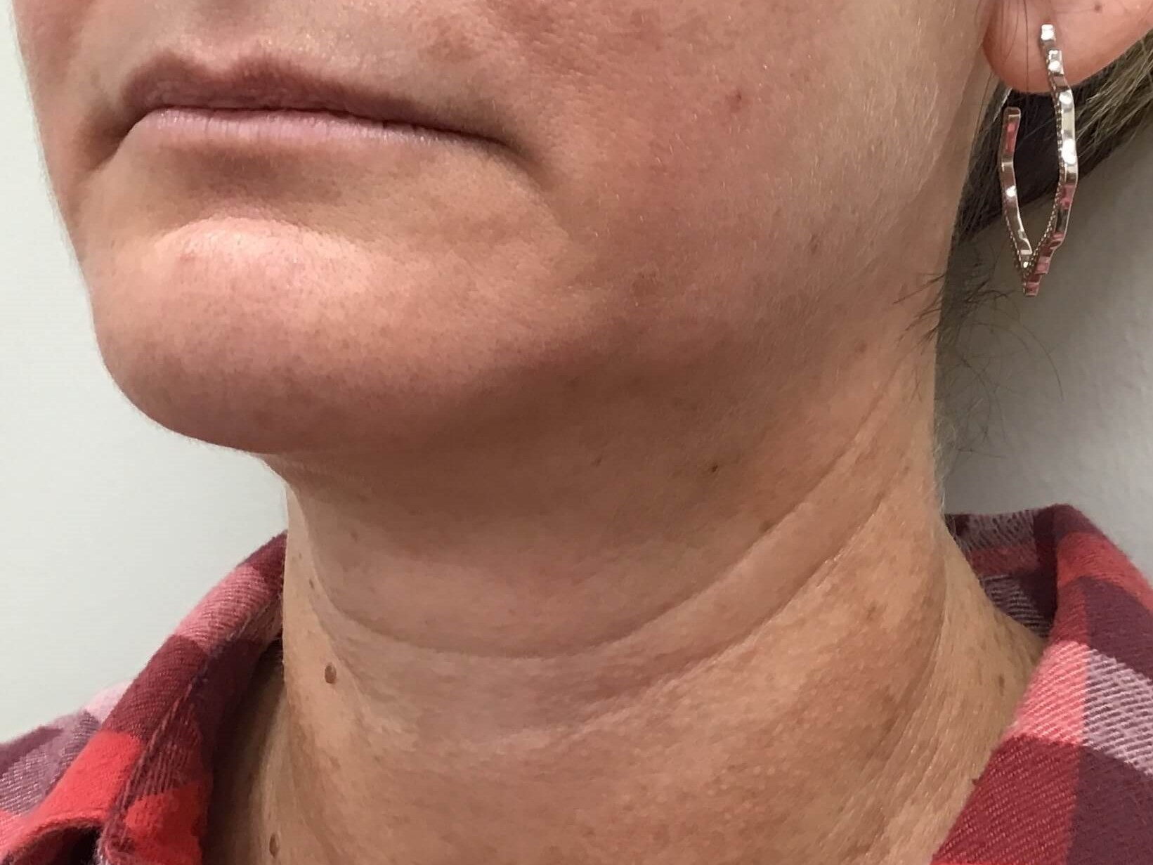 Before and After RF Microneedling Photos