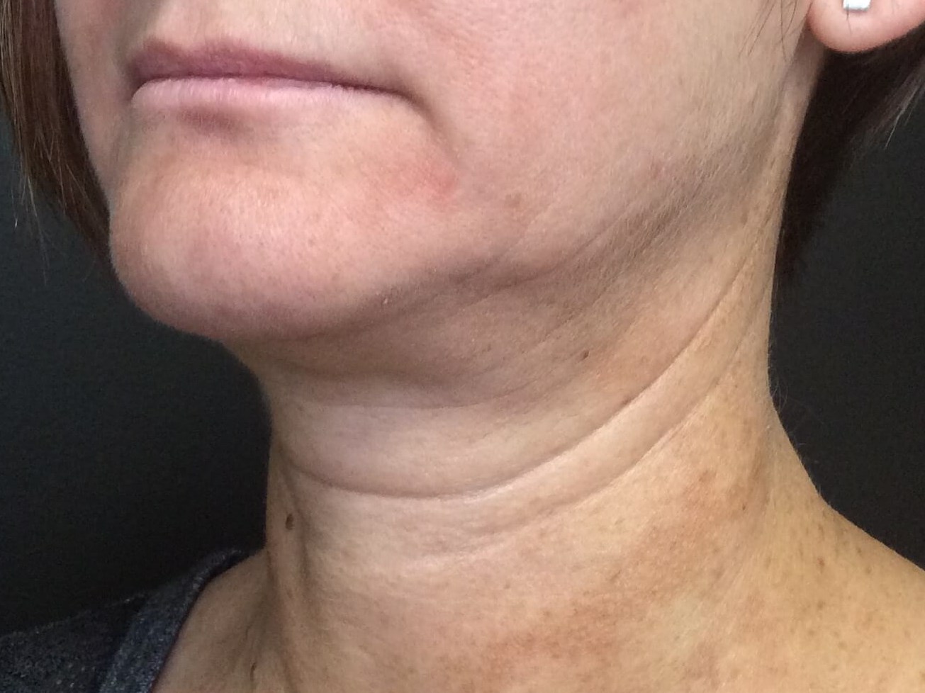 Before And After Rf Microneedling Photos